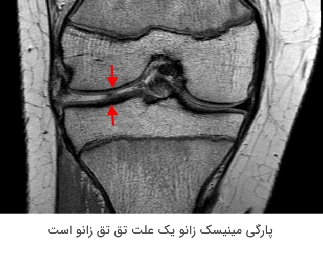 پارگی منیسک از دلایل تق تق زانو