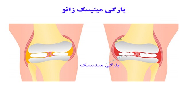 پارگی مینیسک زانو