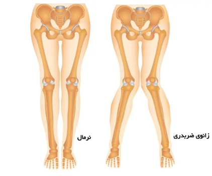 چه مواردی می‌توانند باعث بروز پای ضربدری شوند