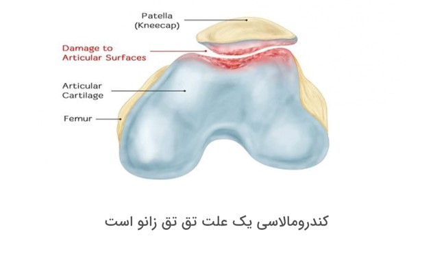کندرومالاسی، علت صدای تق تق زانو