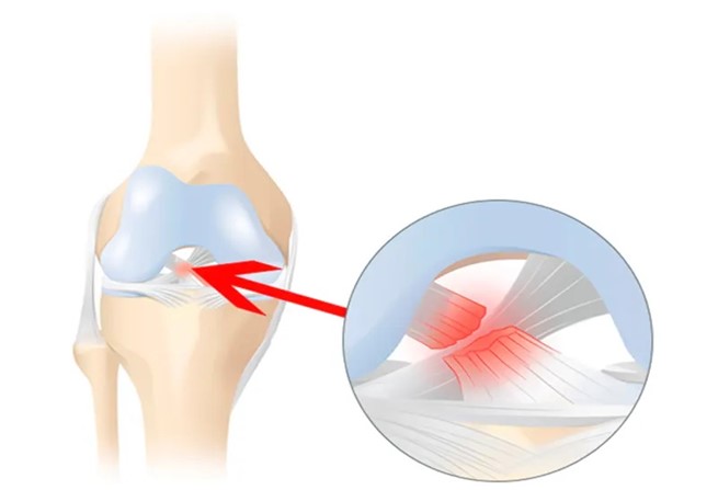 درد کشک زانو